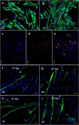 A Functional SNP in the Promoter of LBX1 Is Associated With the Development of Adolescent Idiopathic Scoliosis Through Involvement in the Myogenesis of Paraspinal Muscles